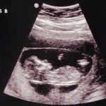Ultrasound picture of Baby B