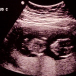 Ultrasound of baby C