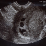 Ultrasound from fertility clinic - 3 sacs, two heartbeats