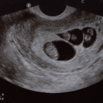 ultrasound - 3 sacs and 3 babies