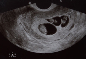 ultrasound - 3 sacs and 3 babies