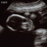 21 week ultrasound of Anderson Triplets Baby C